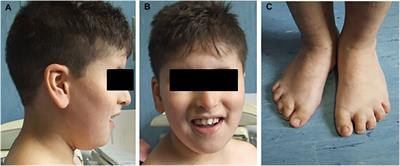 Case Report: A Novel Homozygous Missense Variant of FBN3 Supporting It Is a New Candidate Gene Causative of a Bardet–Biedl Syndrome–Like Phenotype